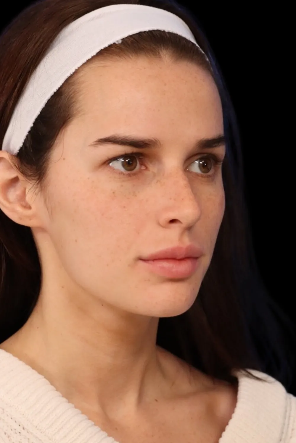 Rhinoplasty case #7923