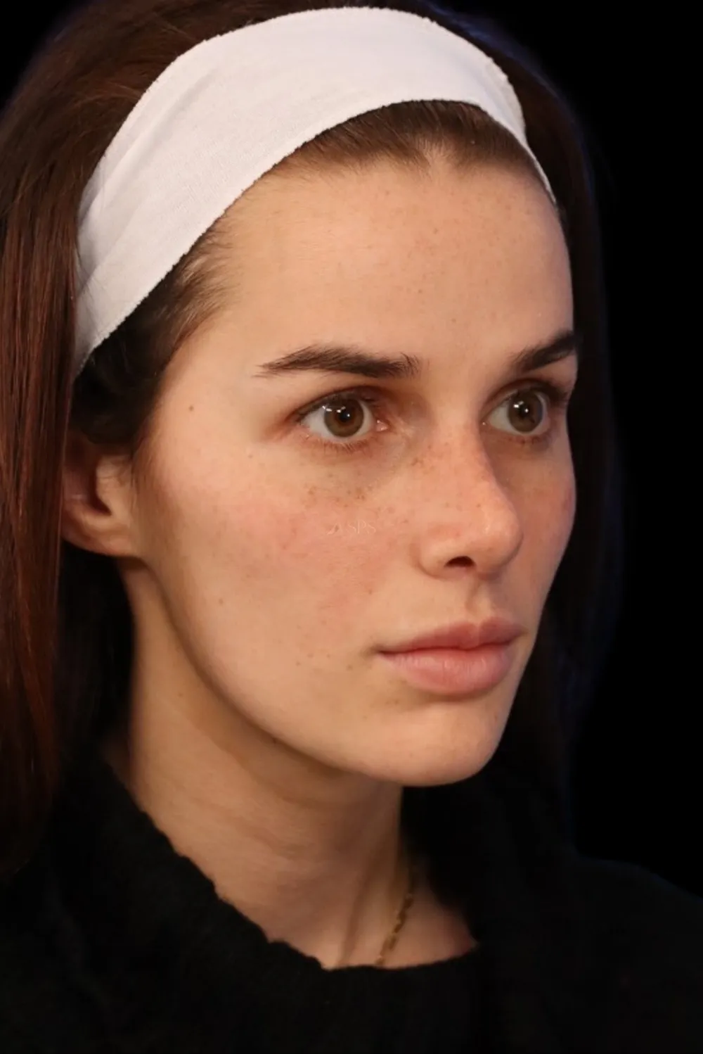 Rhinoplasty case #7923