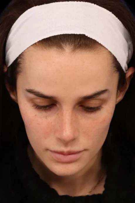 Rhinoplasty case #7923