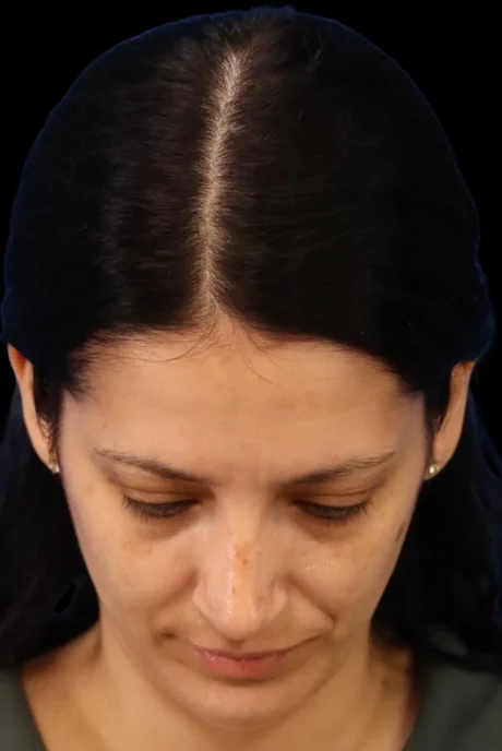 Rhinoplasty case #7949