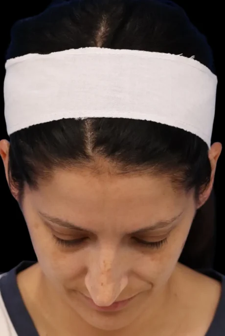 Rhinoplasty case #7949