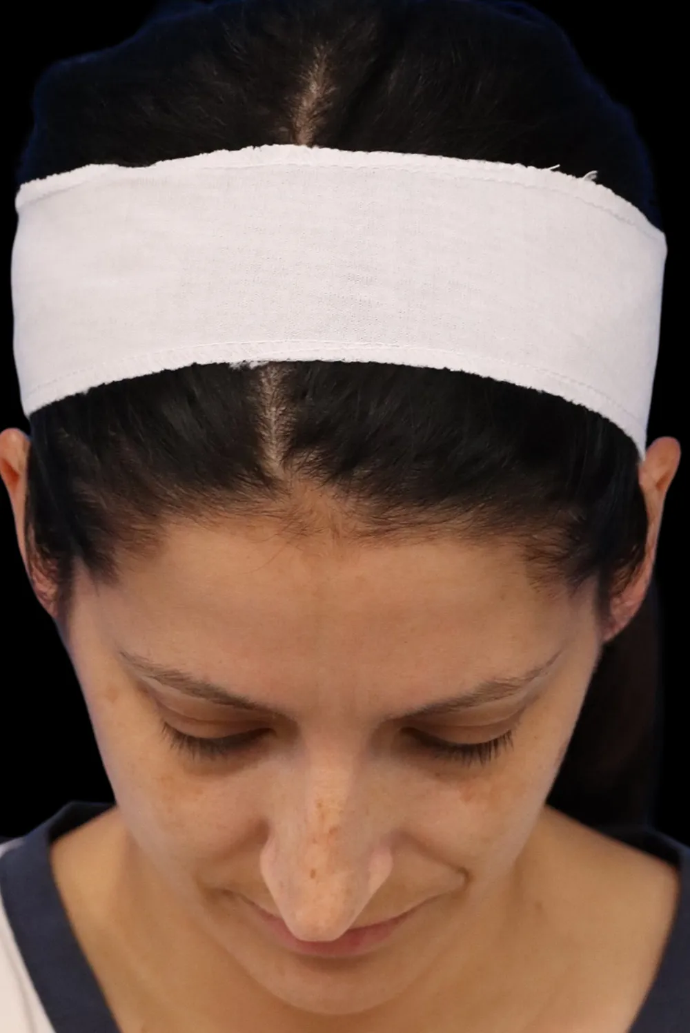 Rhinoplasty case #7949