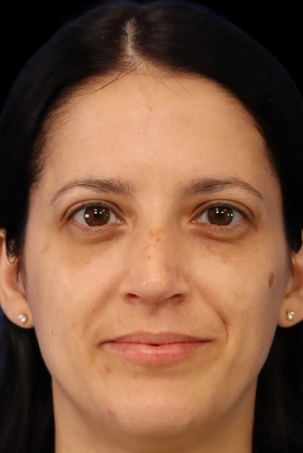 Rhinoplasty case #7949