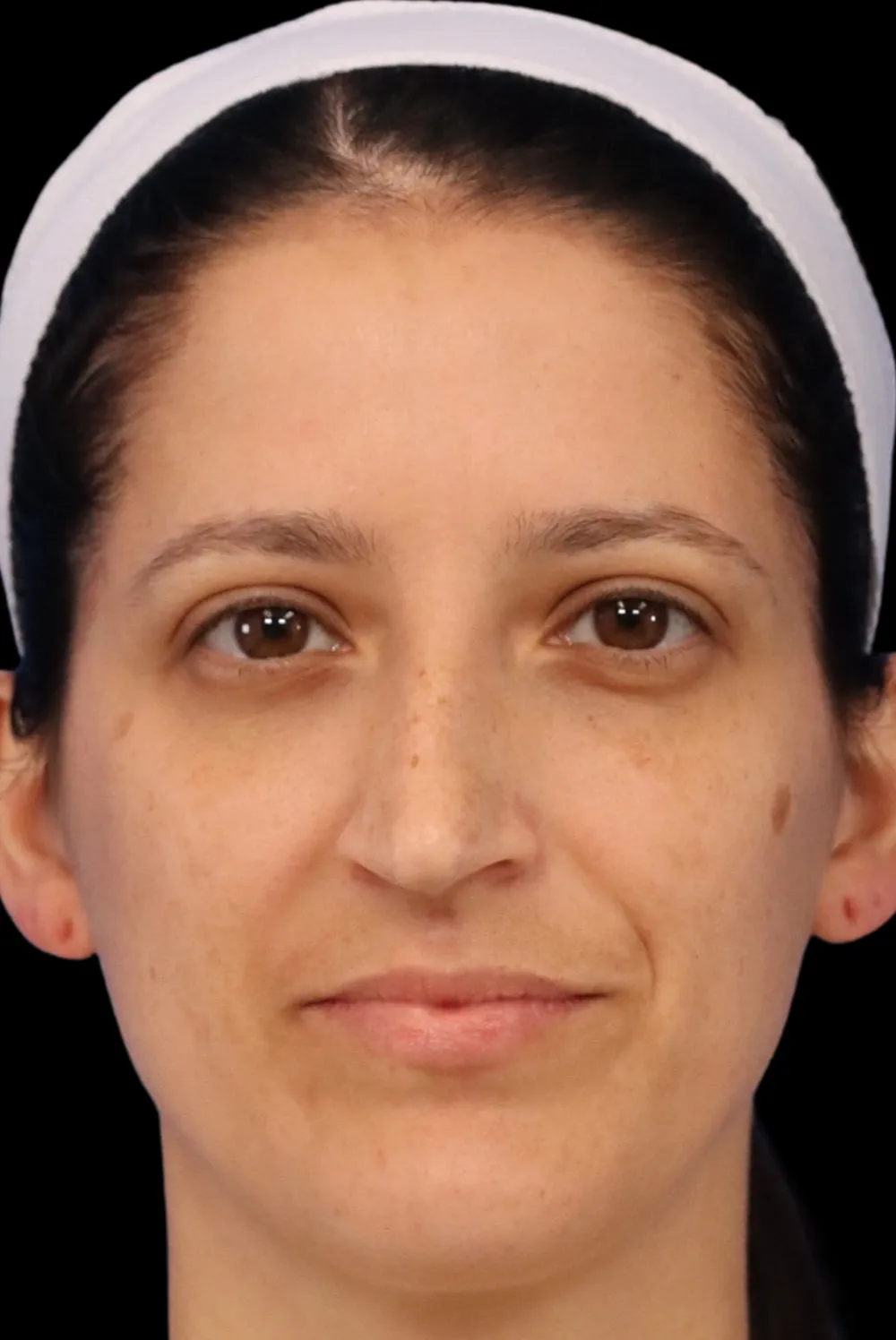 Rhinoplasty case #7949