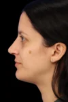 Rhinoplasty case #7949
