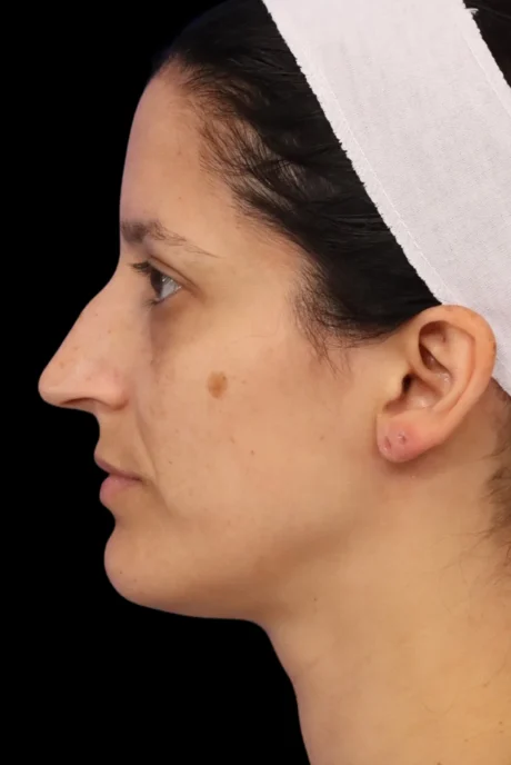 Rhinoplasty case #7949