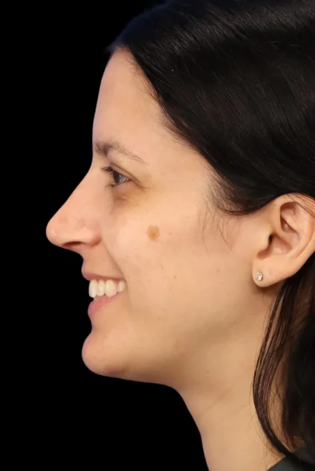 Rhinoplasty case #7949