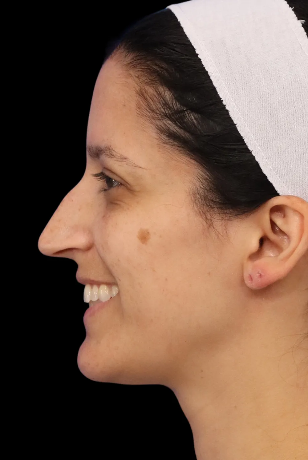 Rhinoplasty case #7949