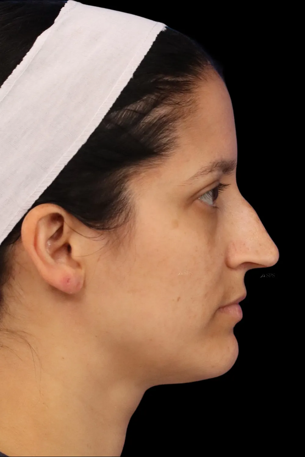 Rhinoplasty case #7949