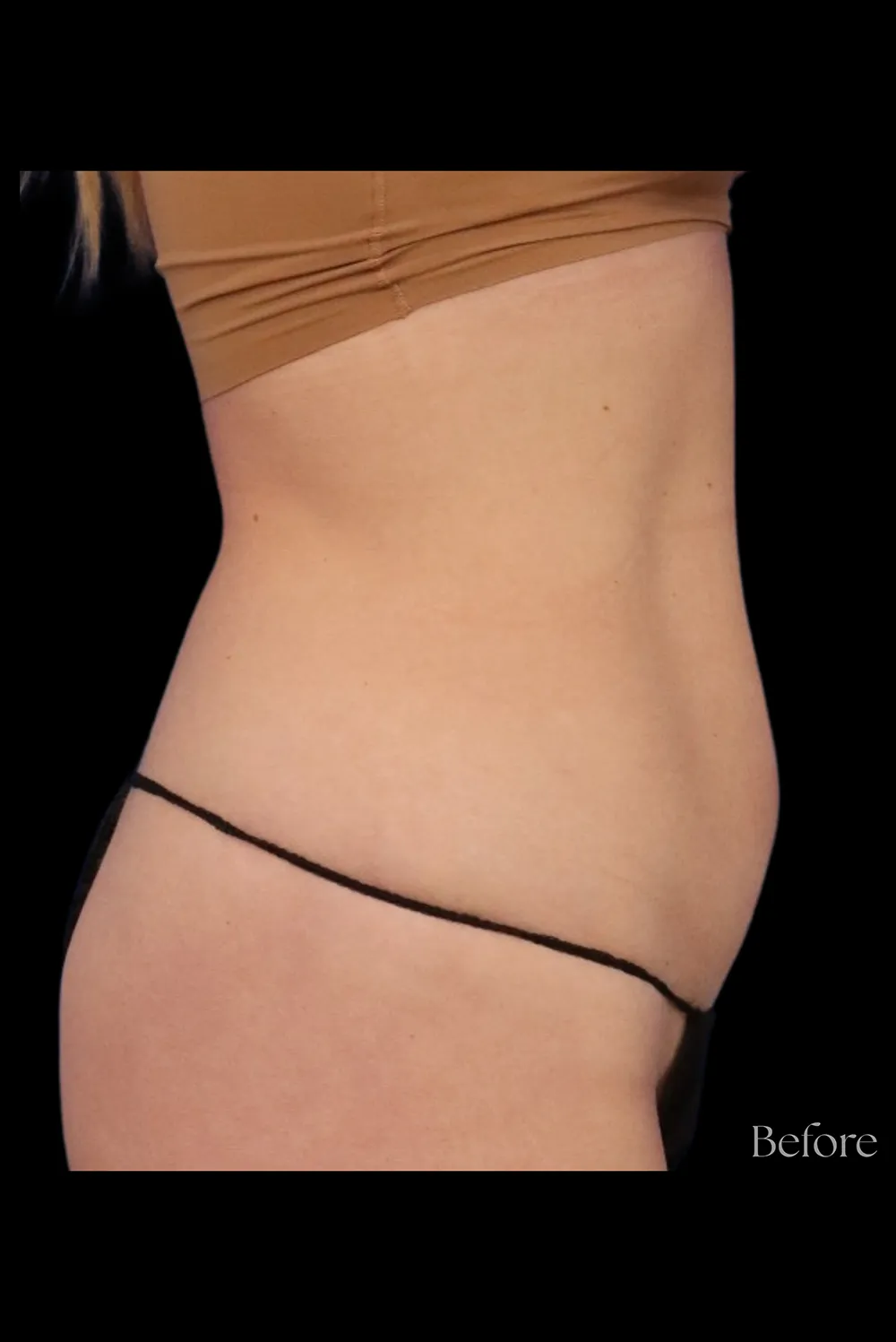 Abdominoplasty case #7971