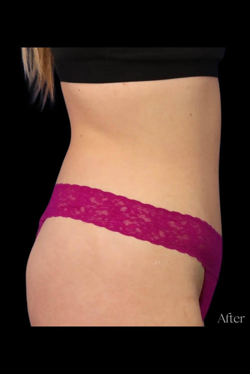 Abdominoplasty case #7971