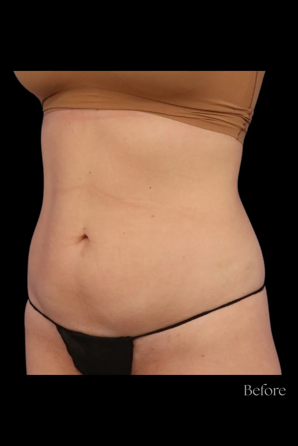 Abdominoplasty case #7971