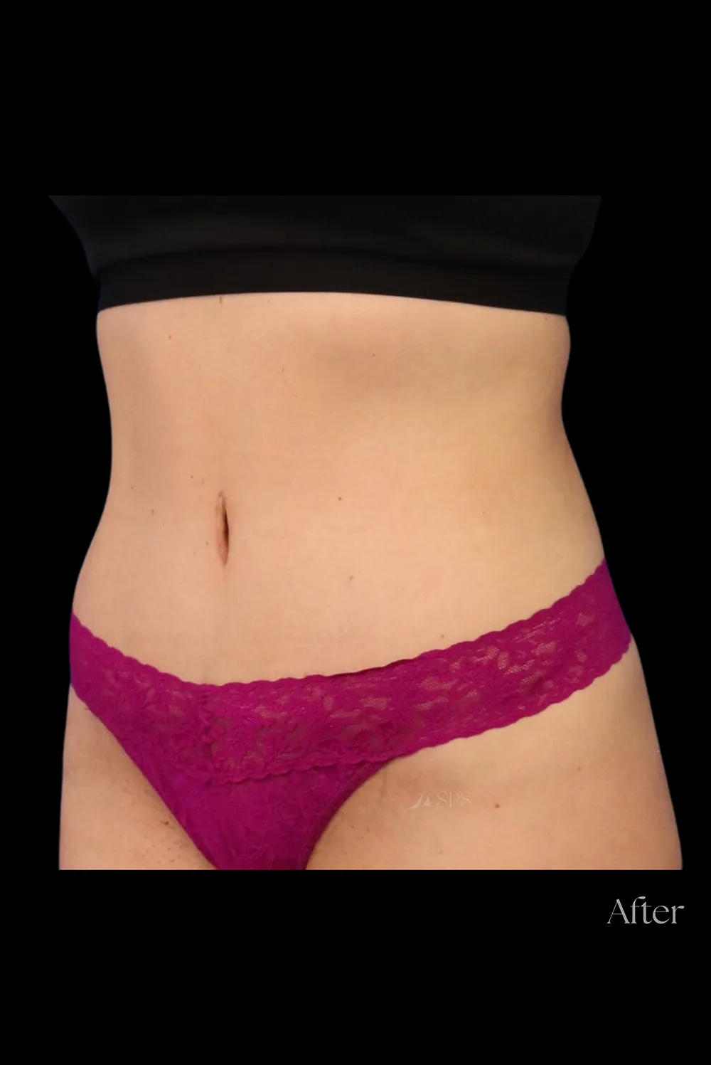 Abdominoplasty case #7971