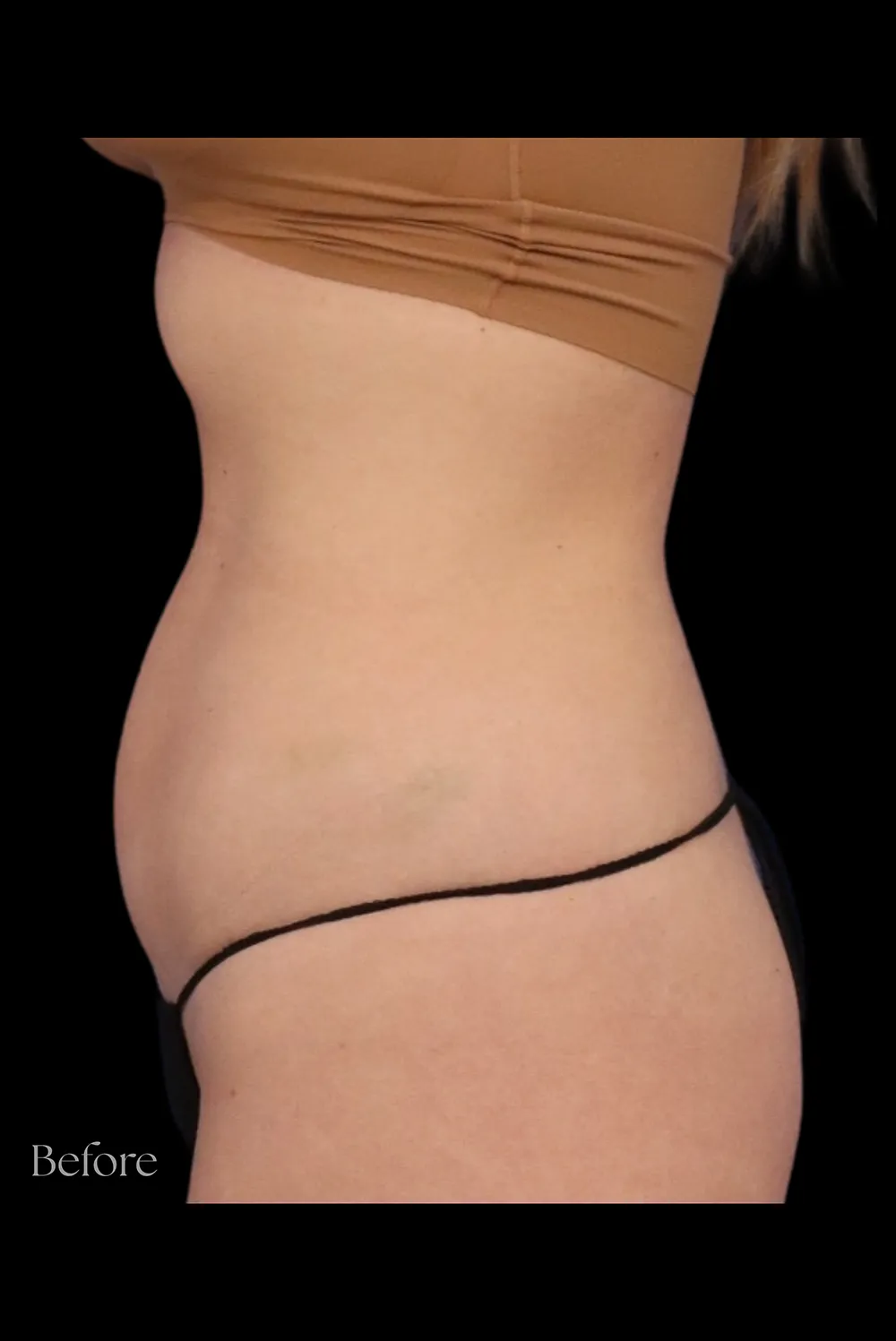 Abdominoplasty case #7971