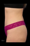 Abdominoplasty case #7971