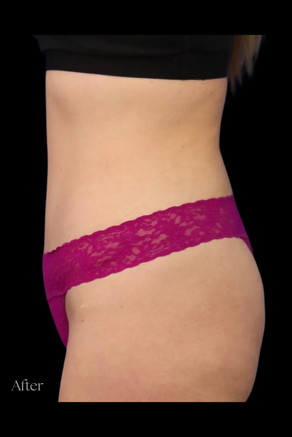 Abdominoplasty case #7971