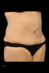 Abdominoplasty case #7982