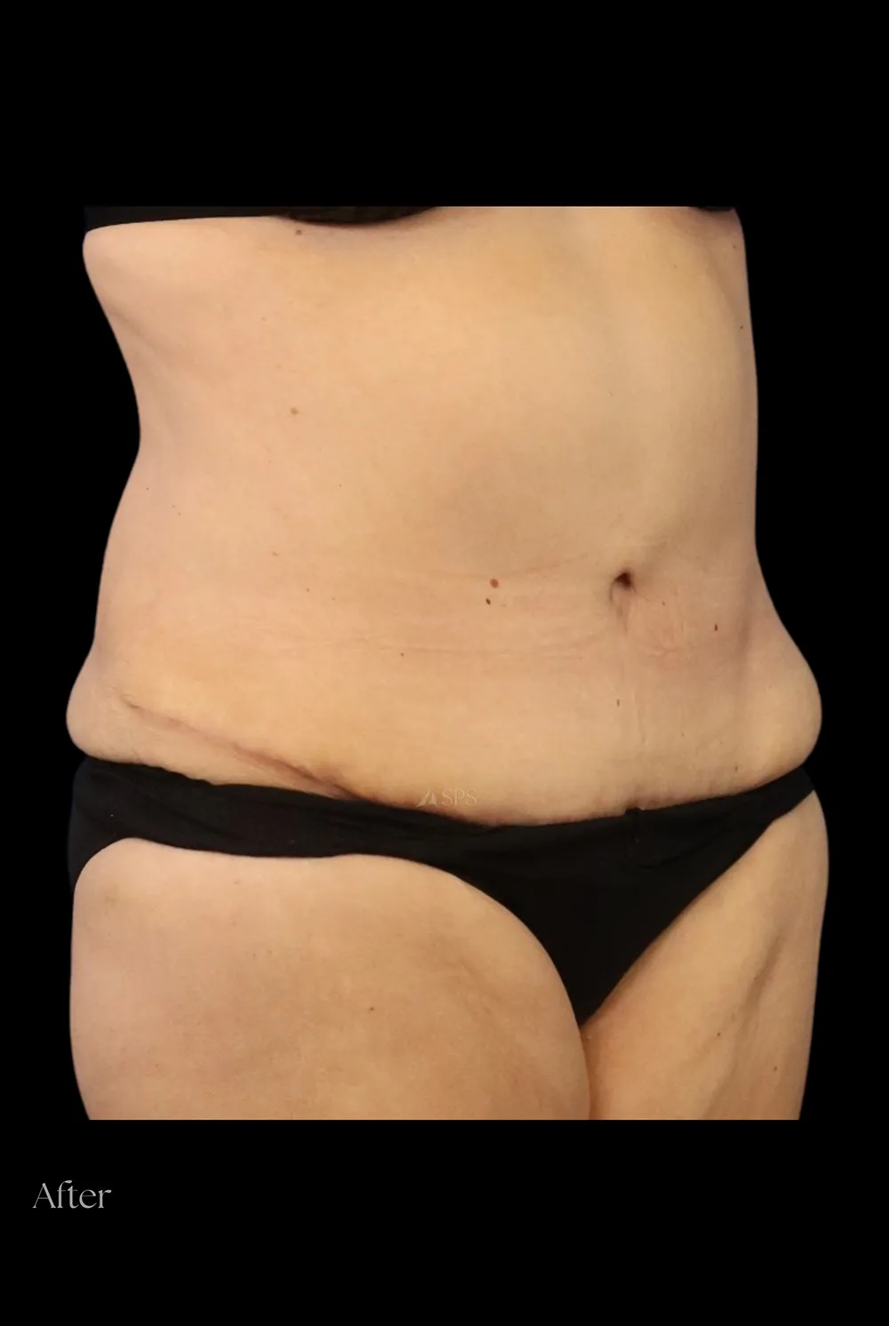 Abdominoplasty case #7982