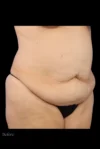 Abdominoplasty case #7982