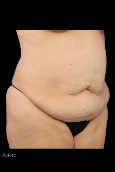 Abdominoplasty case #7982
