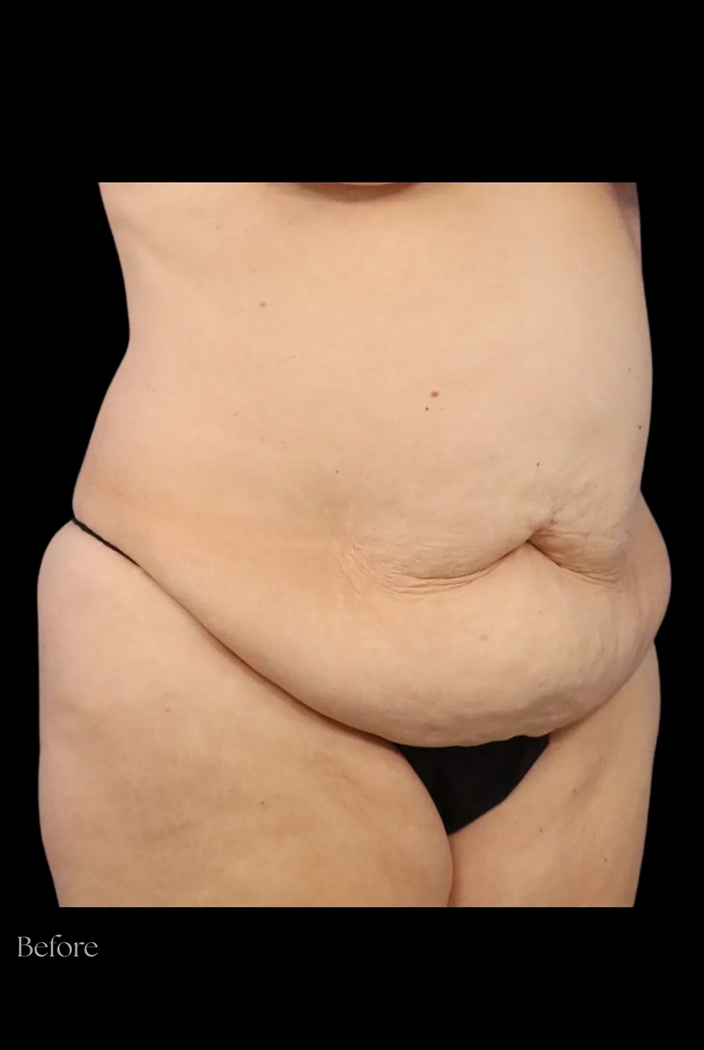 Abdominoplasty case #7982
