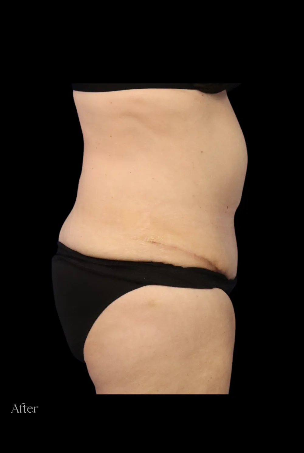 Abdominoplasty case #7982