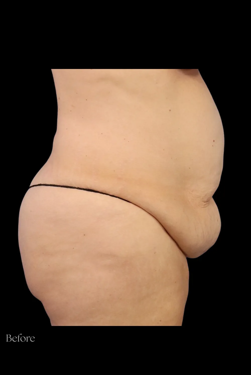 Abdominoplasty case #7982