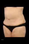 Abdominoplasty case #7982