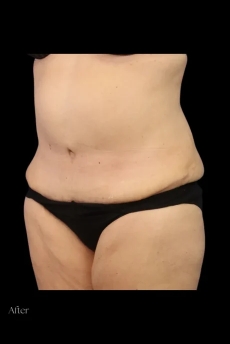 Abdominoplasty case #7982