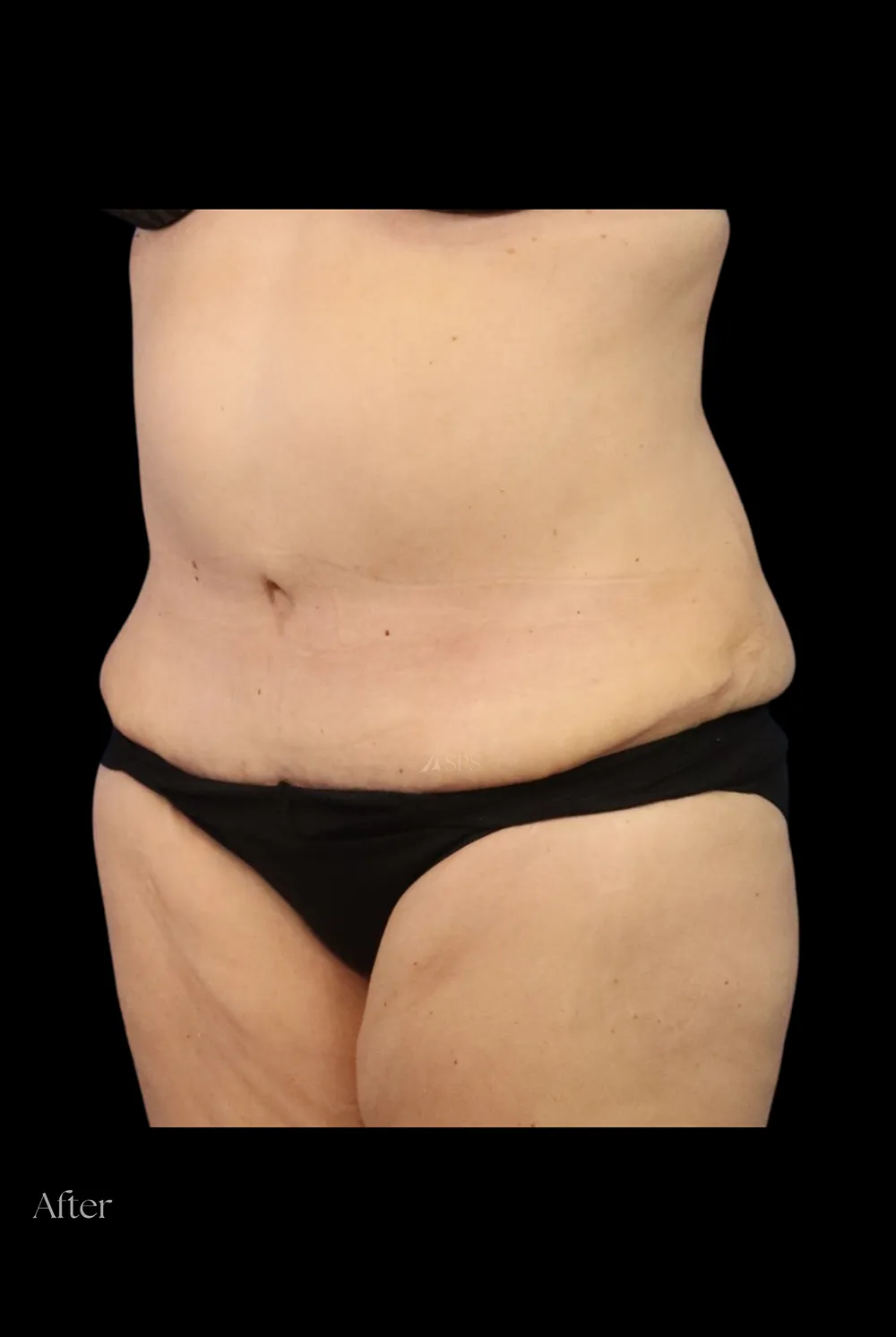 Abdominoplasty case #7982