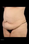Abdominoplasty case #7982