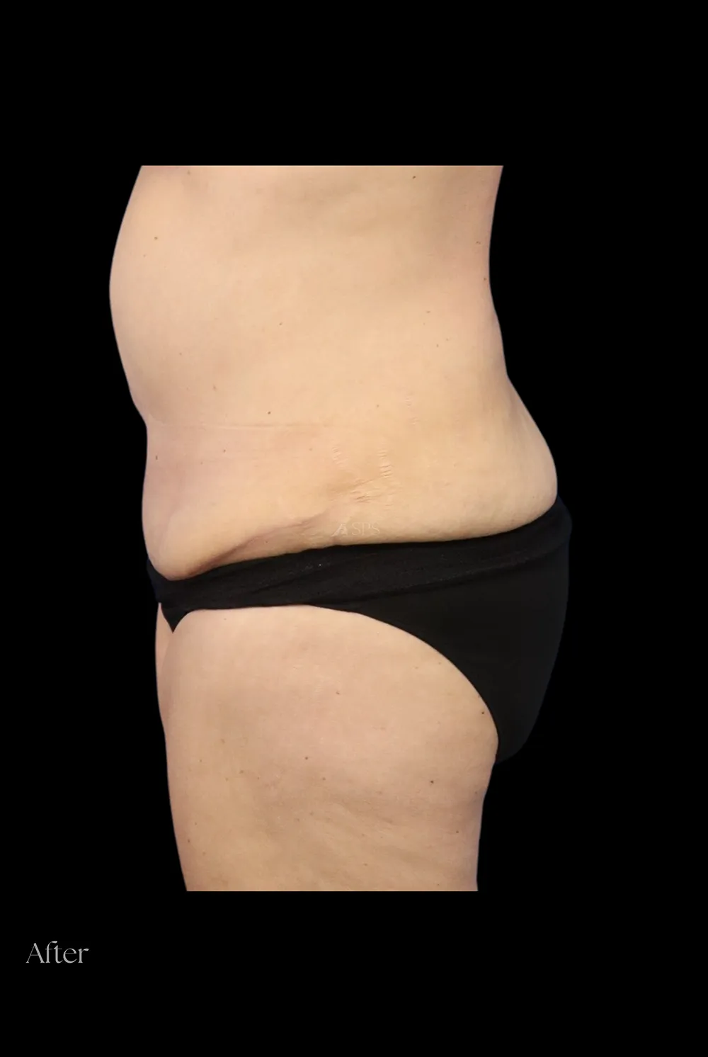 Abdominoplasty case #7982