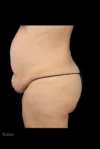 Abdominoplasty case #7982