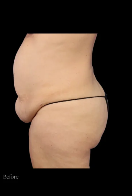 Abdominoplasty case #7982