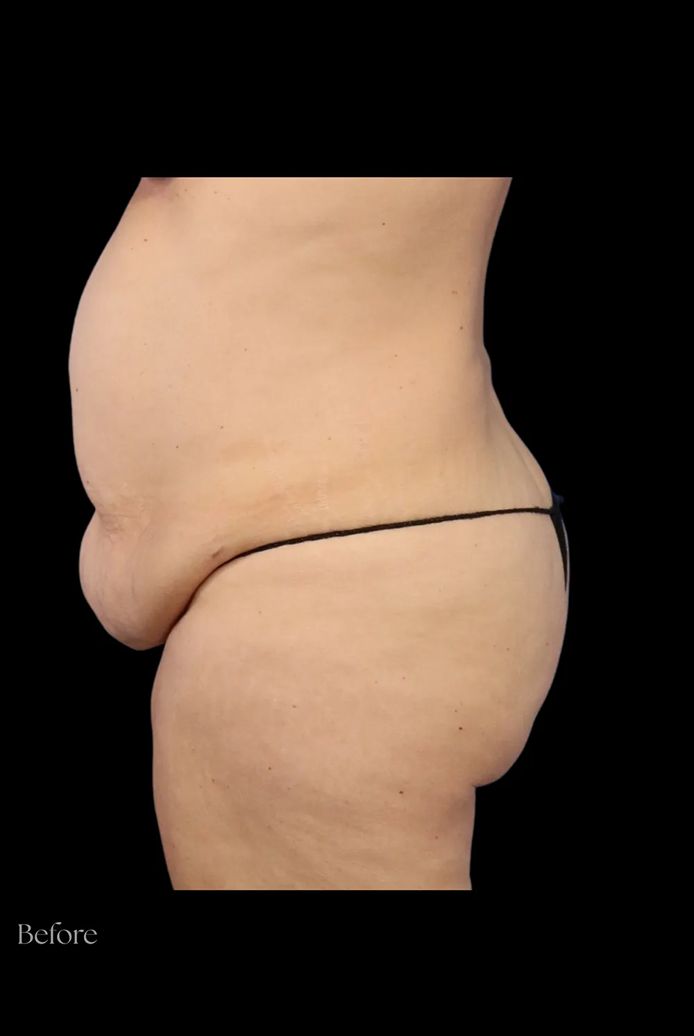 Abdominoplasty case #7982