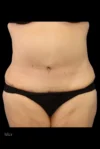 Abdominoplasty case #7982