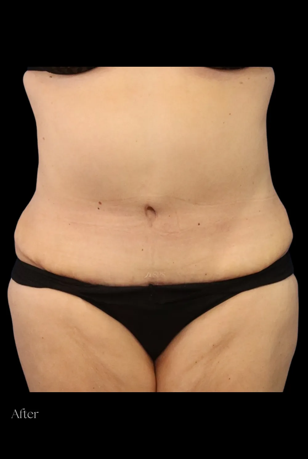 Abdominoplasty case #7982