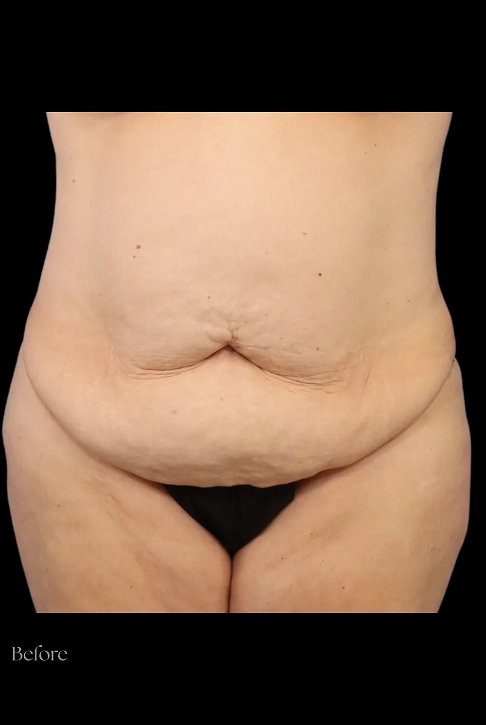 Abdominoplasty case #7982
